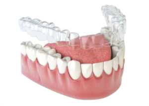 Clear Aligners in Cudahy, WI