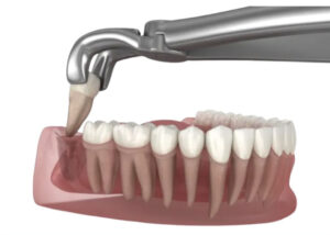 Tooth Extractions in Cudahy, WI