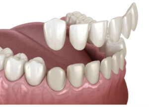 Veneers in Cudahy, WI