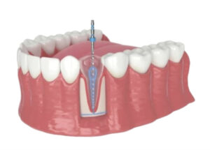 Root Canals in Cudahy, WI