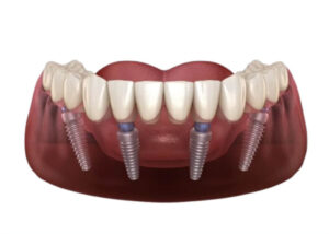 All-on-4 Dental Implants in Cudahy, WI