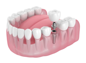 Dental Implants in Cudahy, WI